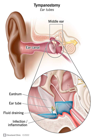 تمپانوستومی Tympanostomy چیست؟ توضیحی کامل درباره عمل جراحی تمپانوستومی 